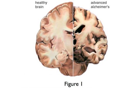 Early dementia and functional brain networks